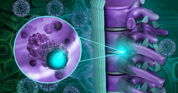Spine Tumours